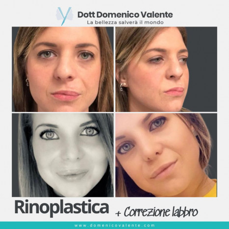Rinoplastica + correzione labbro Dott. Domenico Valente